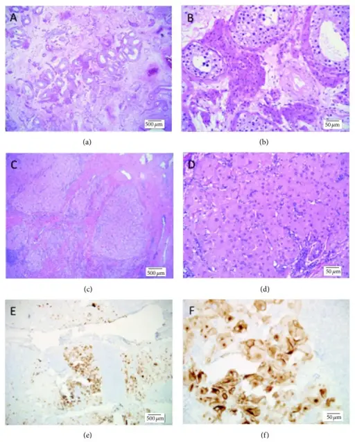 Adrenogenital Syndromes