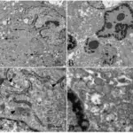 Adrenoleukodystrophy