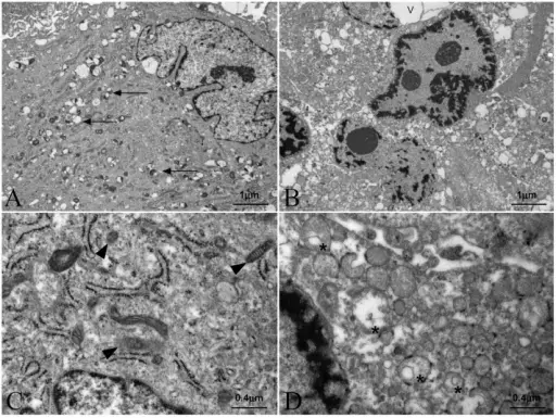 Adrenoleukodystrophy