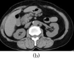 Adult-Onset Medullary Cystic Disease