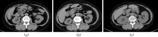 Adult-Onset Medullary Cystic Disease