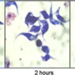 African Trypanosomiasis Infection