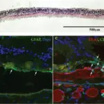 Age Related Macular Degeneration