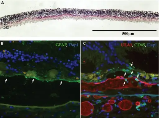 Age Related Macular Degeneration