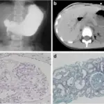 Agenesis of the Kidney