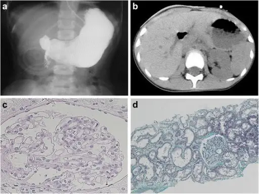 Agenesis of the Kidney