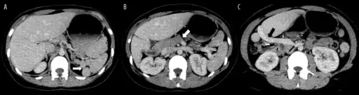 Agenesis of the Pancreas