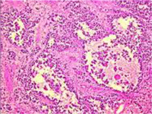 Alveolar Rhabdomyosarcoma