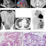 Alveolar Soft Part Sarcoma