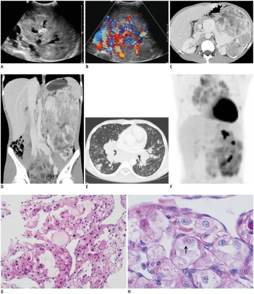 Alveolar Soft Part Sarcoma