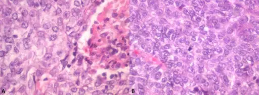 Ameloblastic Carcinoma