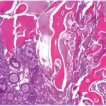 Ameloblastic Fibro-odontoma