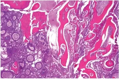 Ameloblastic Fibro-odontoma