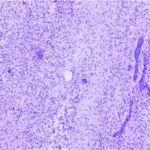 Ameloblastic Fibroma