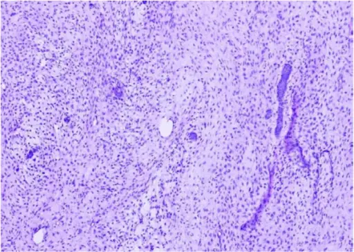 Ameloblastic Fibroma