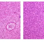 Ameloblastic Fibrosarcoma