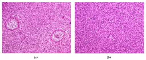 Ameloblastic Fibrosarcoma