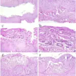 Ameloblastoma