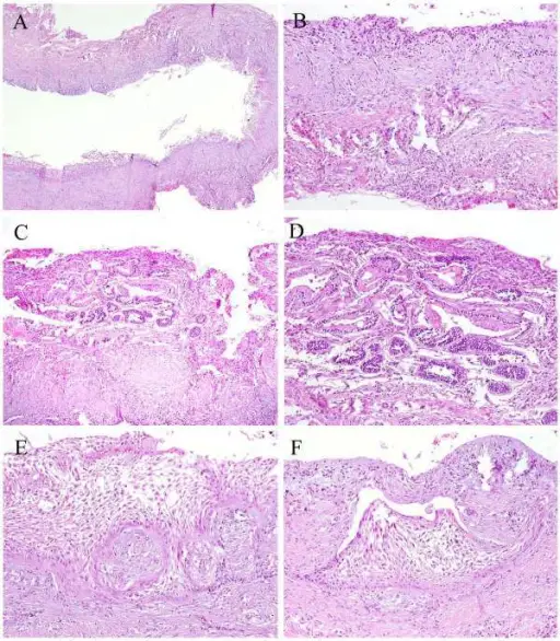 Ameloblastoma