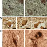 Amyotrophic Lateral Sclerosis