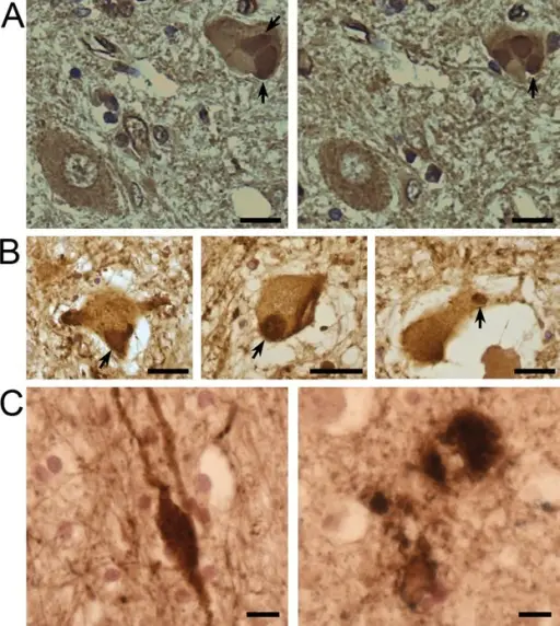 Amyotrophic Lateral Sclerosis