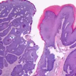 Anal Transition Zone Carcinoma