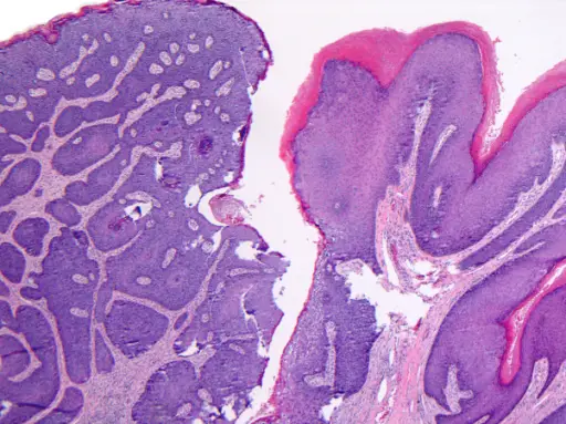 Anal Transition Zone Carcinoma