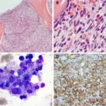 Systemic mastocytosis