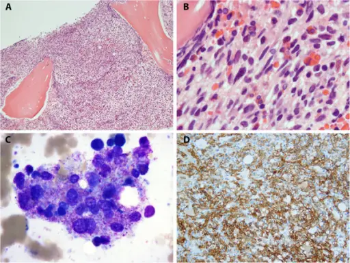 Systemic mastocytosis