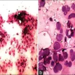 Anaplastic Carcinoma