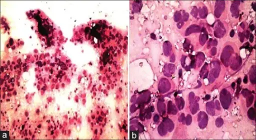 Anaplastic Carcinoma