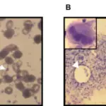 Anemia due to Chronic Blood Loss