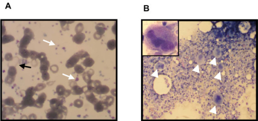 Anemia due to Chronic Blood Loss