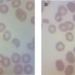 Anemias due to Blood Loss