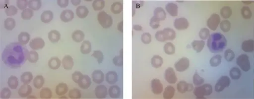 Anemias due to Blood Loss