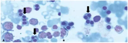 Anemias of Diminished Erythropoiesis