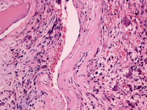 Aneurysmal Bone Cyst