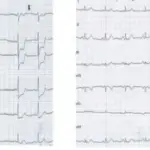 Angina Pectoris