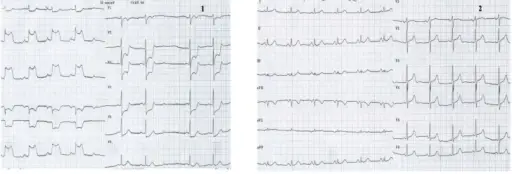 Angina Pectoris