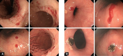 Angiodysplasia