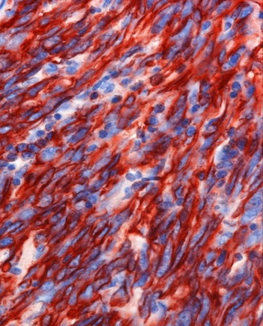 Angiosarcoma Positive CD31