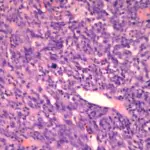 Angiosarcoma