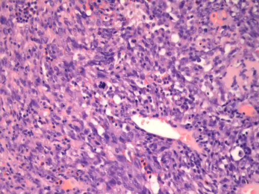 Angiosarcoma