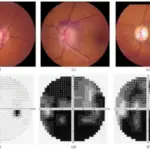 Anterior Ischemic Optic Neuropathy