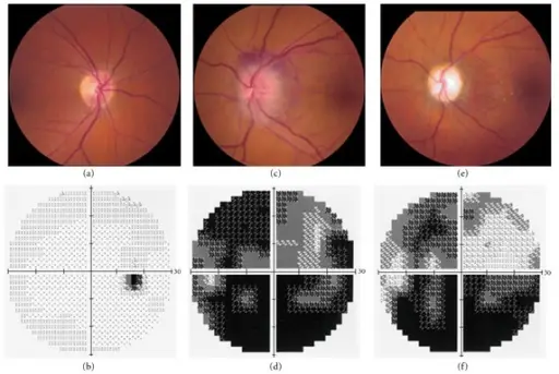 Anterior Ischemic Optic Neuropathy