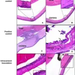 Anterior Segment Pathology