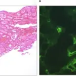 Antibody-Mediated Rejections in Transplant Rejections