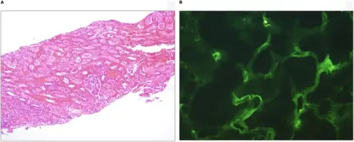 Antibody-Mediated Rejections in Transplant Rejections