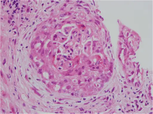 Antineutrophil Cytoplasmic Antibodies Vasculitis