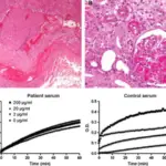 Antiphospholipid Antibody Syndrome